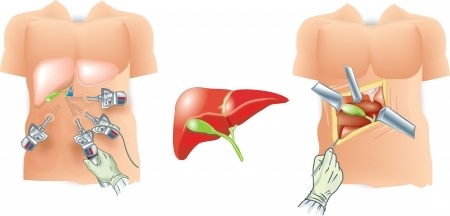 Laparoscopic Gallbladder Removal