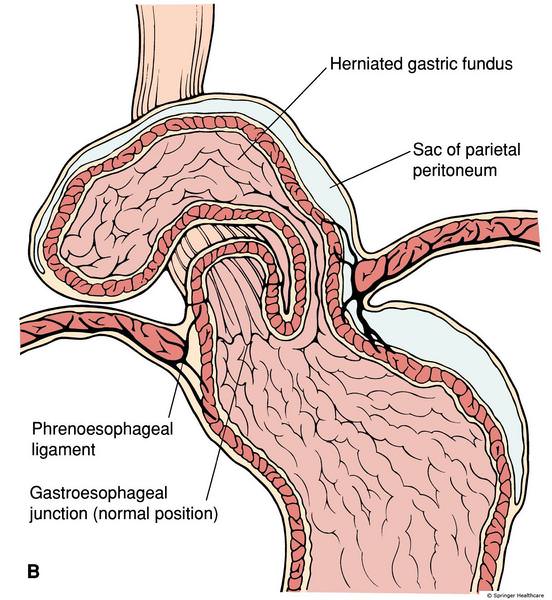 Paraesophageal Hernia Dr Scott Laker Michigan Surgery