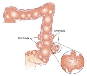 Multiple-diverticula-of-the-colon