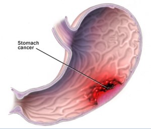 stomach-cancer-tumor