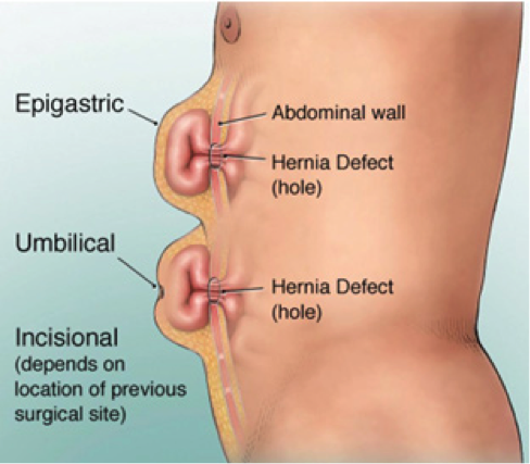 epigastric hernia